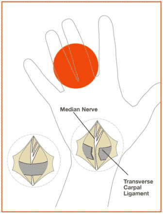 Diagram of Carpal Tunnel Surgery